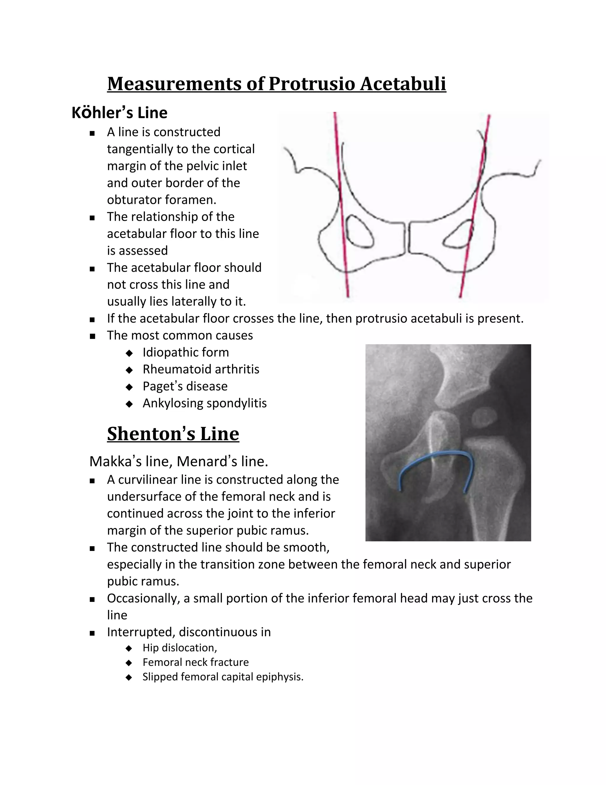 Measurements of Protrusio Acetabuli
Köhler’s Line
     A line is constructed
      tangentially to the cortical
      margin of the pelvic inlet
      and outer border of the
      obturator foramen.
     The relationship of the
      acetabular floor to this line
      is assessed
     The acetabular floor should
      not cross this line and
      usually lies laterally to it.
     If the acetabular floor crosses the line, then protrusio acetabuli is present.
     The most common causes
           Idiopathic form
           Rheumatoid arthritis
           Paget’s disease
           Ankylosing spondylitis


      Shenton’s Line
  Makka’s line, Menard’s line.
     A curvilinear line is constructed along the
      undersurface of the femoral neck and is
      continued across the joint to the inferior
      margin of the superior pubic ramus.
     The constructed line should be smooth,
      especially in the transition zone between the femoral neck and superior
      pubic ramus.
     Occasionally, a small portion of the inferior femoral head may just cross the
      line
     Interrupted, discontinuous in
            Hip dislocation,
            Femoral neck fracture
            Slipped femoral capital epiphysis.
 