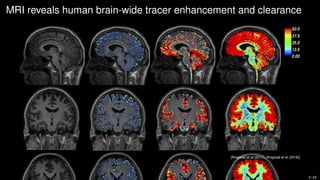 MRI reveals human brain-wide tracer enhancement and clearance
[Ringstad et al (2017), Ringstad et al (2018)]
3 / 24
 