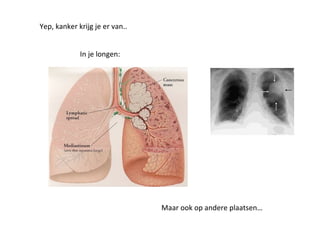 Yep, kanker krijg je er van..
In je longen:
Maar ook op andere plaatsen…
 