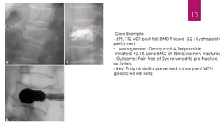 Subsequent Fall Role of Biosimilars in Managing Osteoporotic Vertebral Compression ...