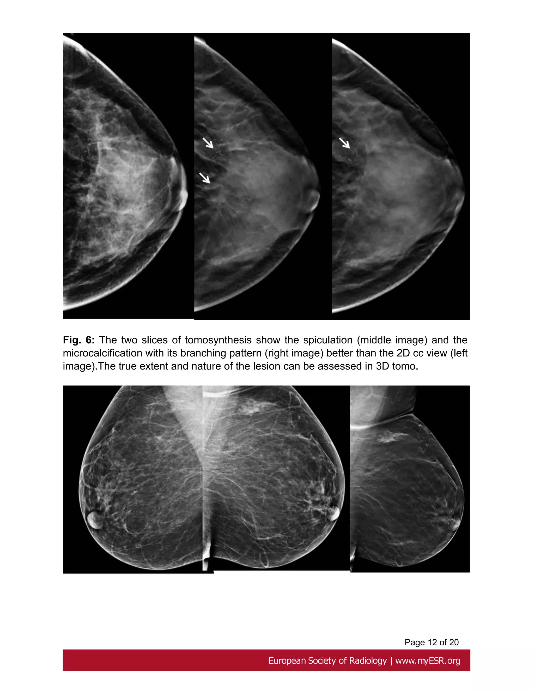 Role Of Breast Tomosynthesis In The Morphological Analysis Of Breast role-of-breast-tomosynthesis-in-the-morphological-analysis-of-breast