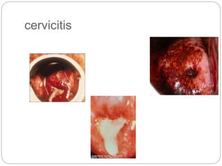 Role of cervical cancer screening in identifying untreated chronic ...