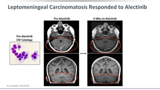 Pre-Alectinib 6 Wks on Alectinib
Pre-Alectinib
CSF Cytology
Leptomeningeal Carcinomatosis Responded to Alectinib
Ou. Oncologist. 2015;20:224.
 