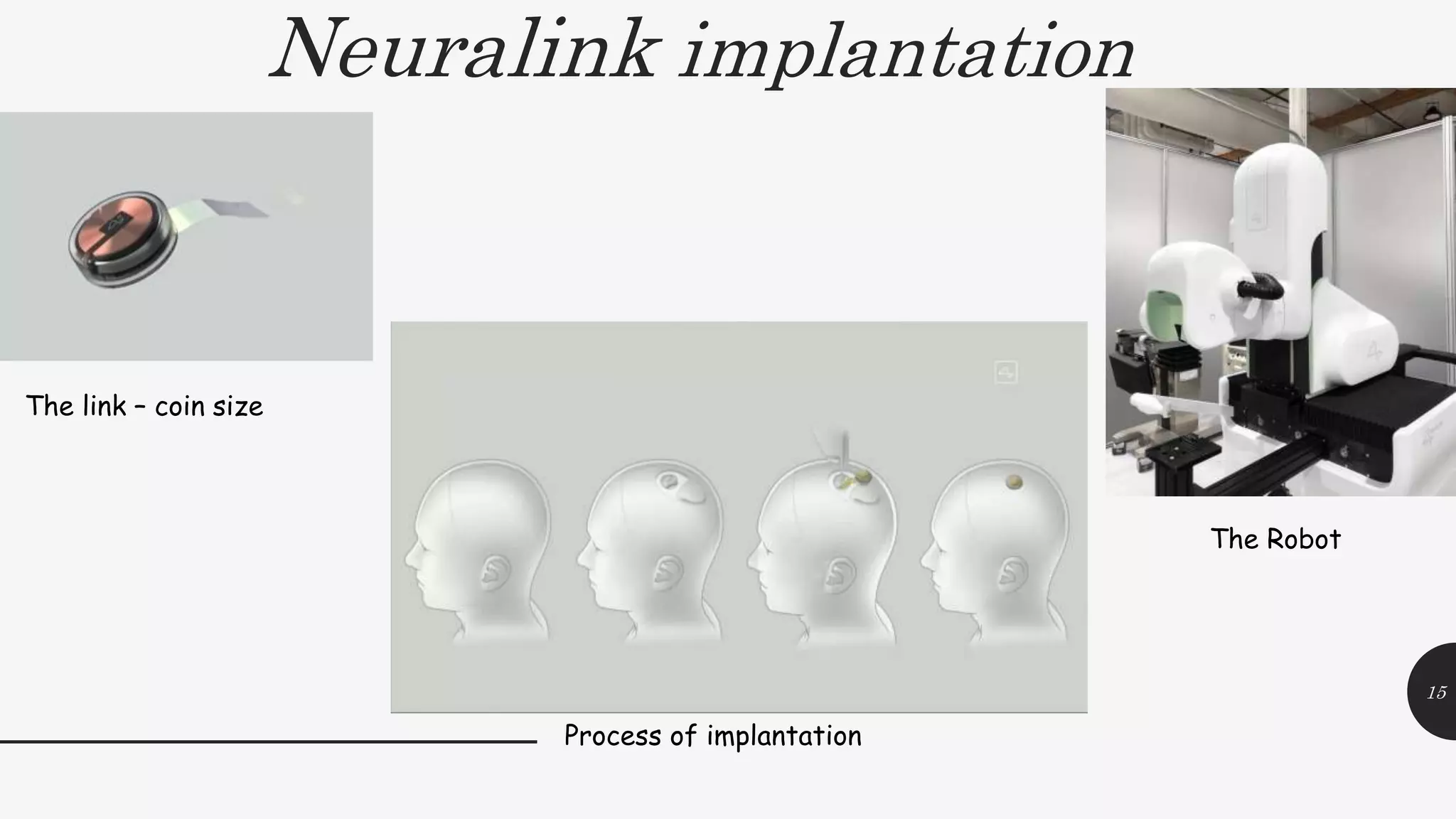Neuralink implantation
15
The link – coin size
The Robot
Process of implantation
 