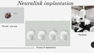 Neuralink implantation
15
The link – coin size
The Robot
Process of implantation
 