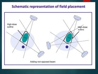 Role of Conformal Radiotherapy in HNC | PPTX