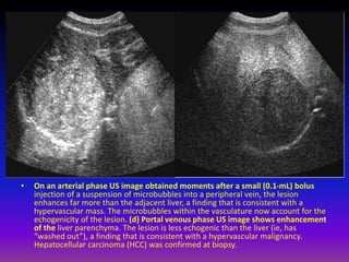 Microavulsion Role of contrast enhanced ultrasonography in characterization of ...