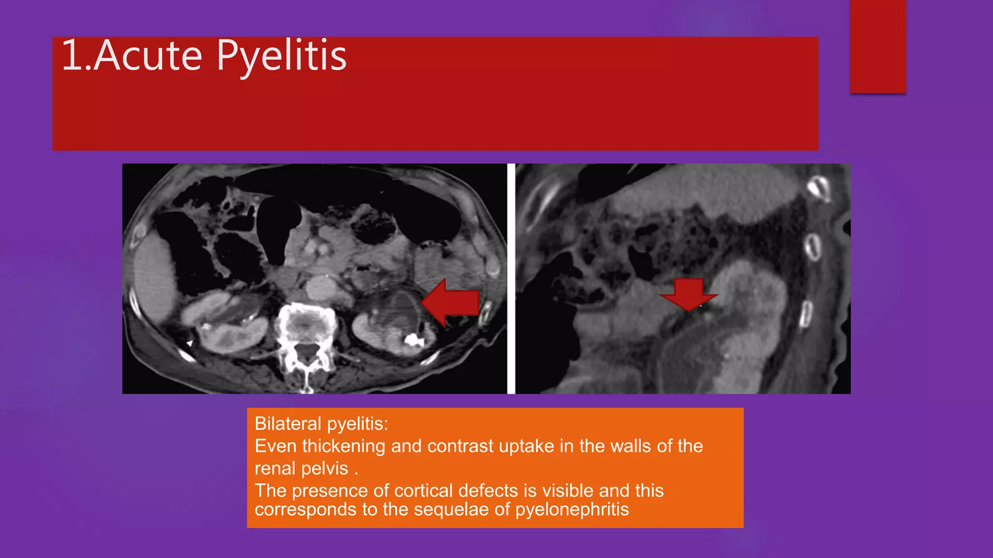 Role of imaging in urosepsis | PPTX