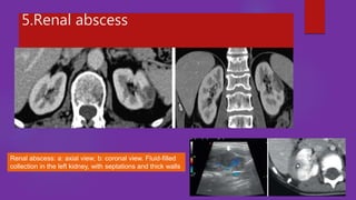 Role of imaging in urosepsis | PPTX