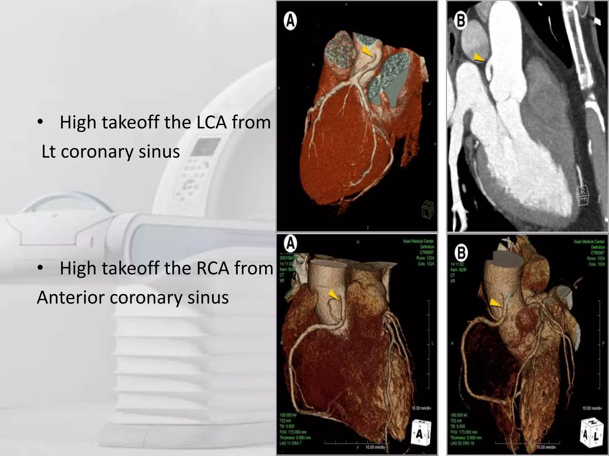 Role of ct angiography in diagnosis of coronary anomalies | PPT | Free ...