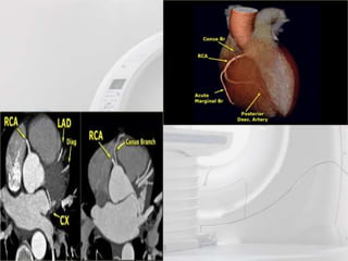 Role of ct angiography in diagnosis of coronary anomalies | PPTX