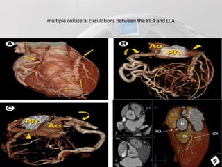 Role of ct angiography in diagnosis of coronary anomalies | PPTX