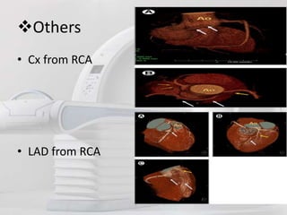 Role of ct angiography in diagnosis of coronary anomalies | PPTX