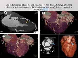 Role of ct angiography in diagnosis of coronary anomalies | PPTX