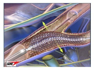 Role of embolic protection device in coronary and carotid intervention ...