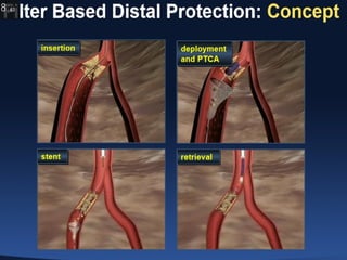 Role of embolic protection device in coronary and carotid intervention ...
