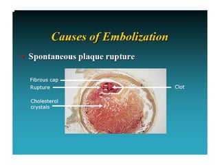 Role of embolic protection device in coronary and carotid intervention ...