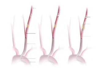 Role of embolic protection device in coronary and carotid intervention ...