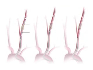 Embolic Device Role of embolic protection device in coronary and carotid intervention ...