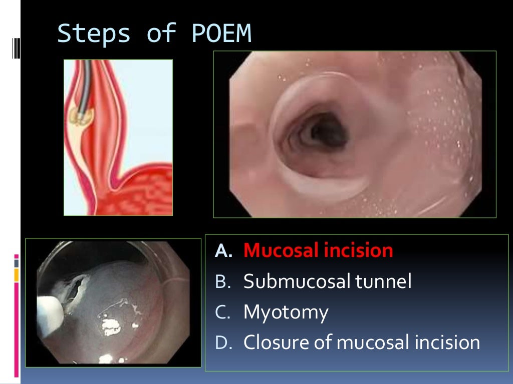 Role of endoscopy in achalasia and gerd