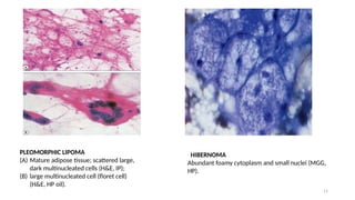 Flooret Cells ROLE OF FNAC IN SOFT TISSUE TUMORS.pptx