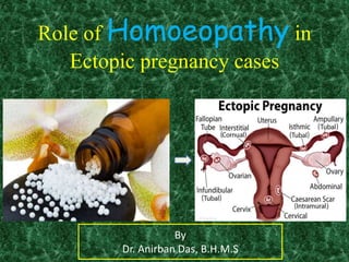 Role of Homoeopathy in
Ectopic pregnancy cases
By
Dr. Anirban Das, B.H.M.S
 