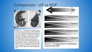 Nsip Classification Role of hrct in interstitial lung diseases pk upload | PPTX