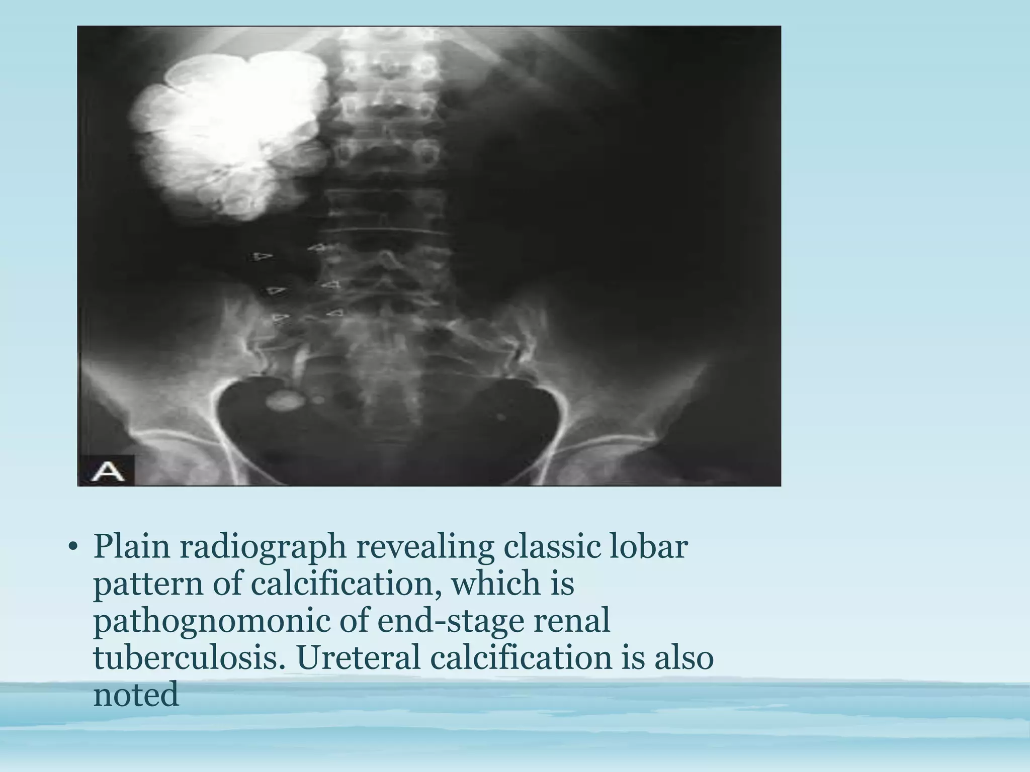 Role of imaging in renal tuberculosis | PPTX
