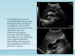 Caliectasis Radiopaedia Role of imaging in renal tuberculosis | PPTX