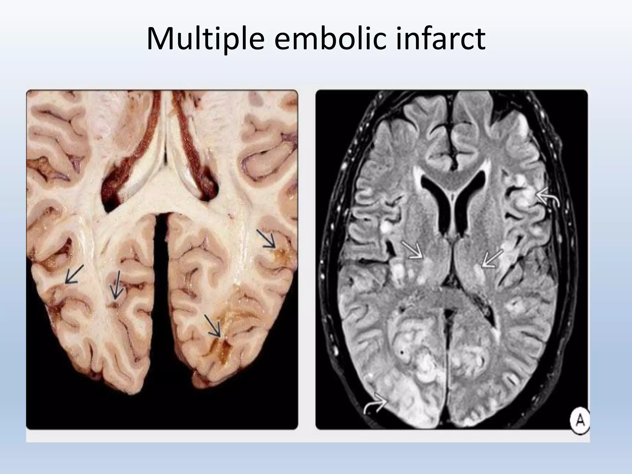 Role of imaging in stroke pk pdf ppt | PDF