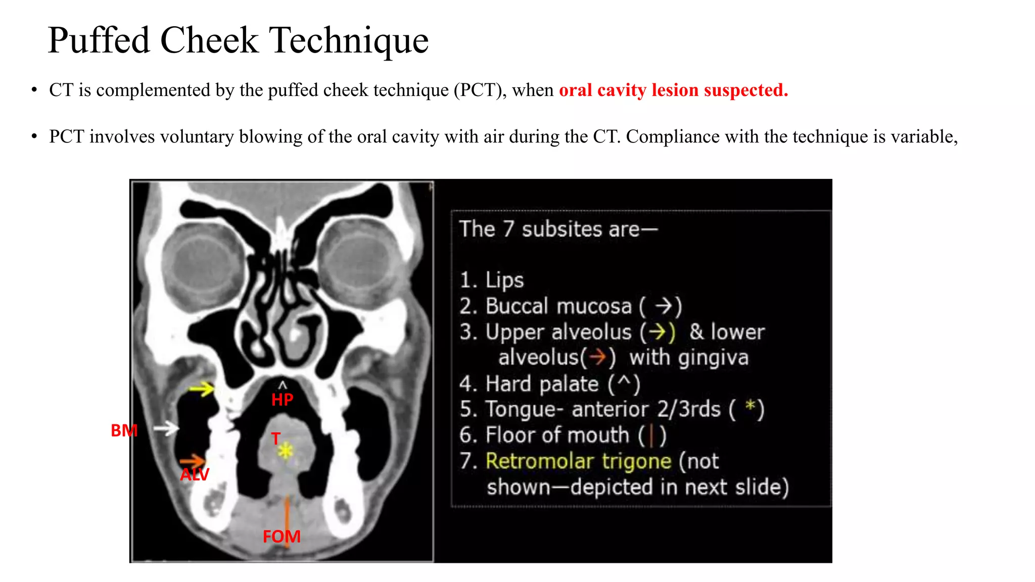 • CT is complemented by the puffed cheek technique (PCT), when oral cavity lesion suspected.
• PCT involves voluntary blowing of the oral cavity with air during the CT. Compliance with the technique is variable,
Puffed Cheek Technique
T
ALV
HP
BM
FOM
 