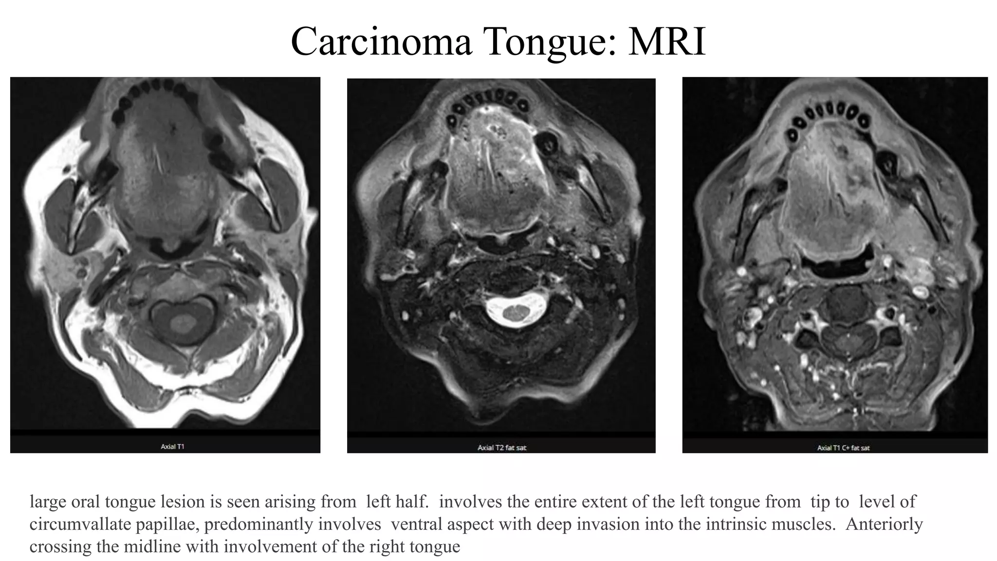 Carcinoma Tongue: MRI
large oral tongue lesion is seen arising from left half. involves the entire extent of the left tongue from tip to level of
circumvallate papillae, predominantly involves ventral aspect with deep invasion into the intrinsic muscles. Anteriorly
crossing the midline with involvement of the right tongue
 