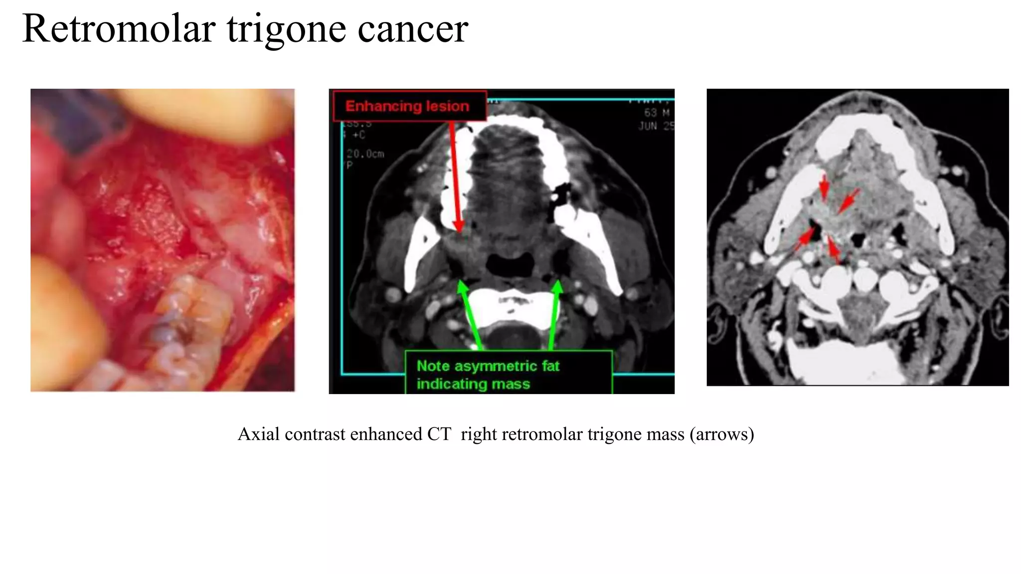 Retromolar trigone cancer
Axial contrast enhanced CT right retromolar trigone mass (arrows)
 