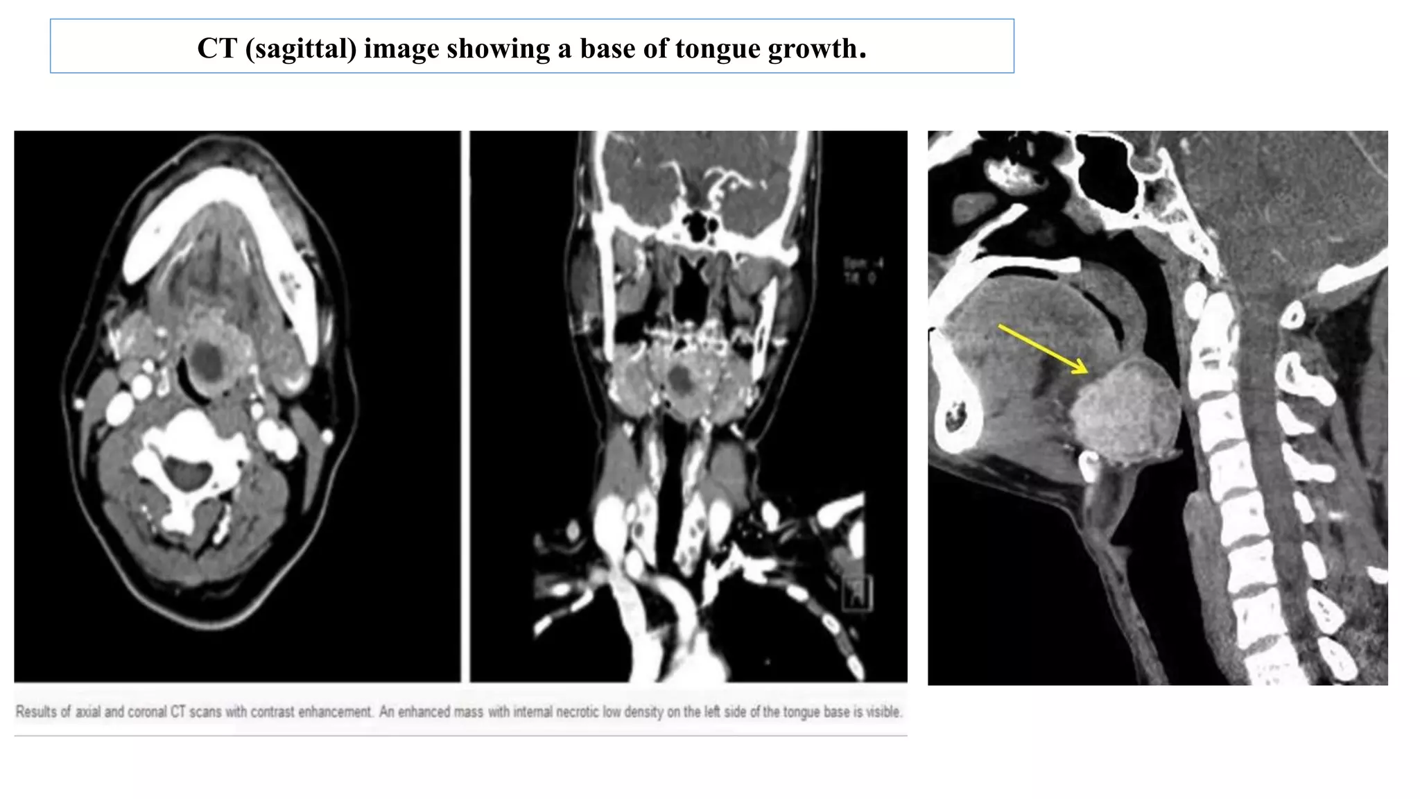 CT (sagittal) image showing a base of tongue growth.
 