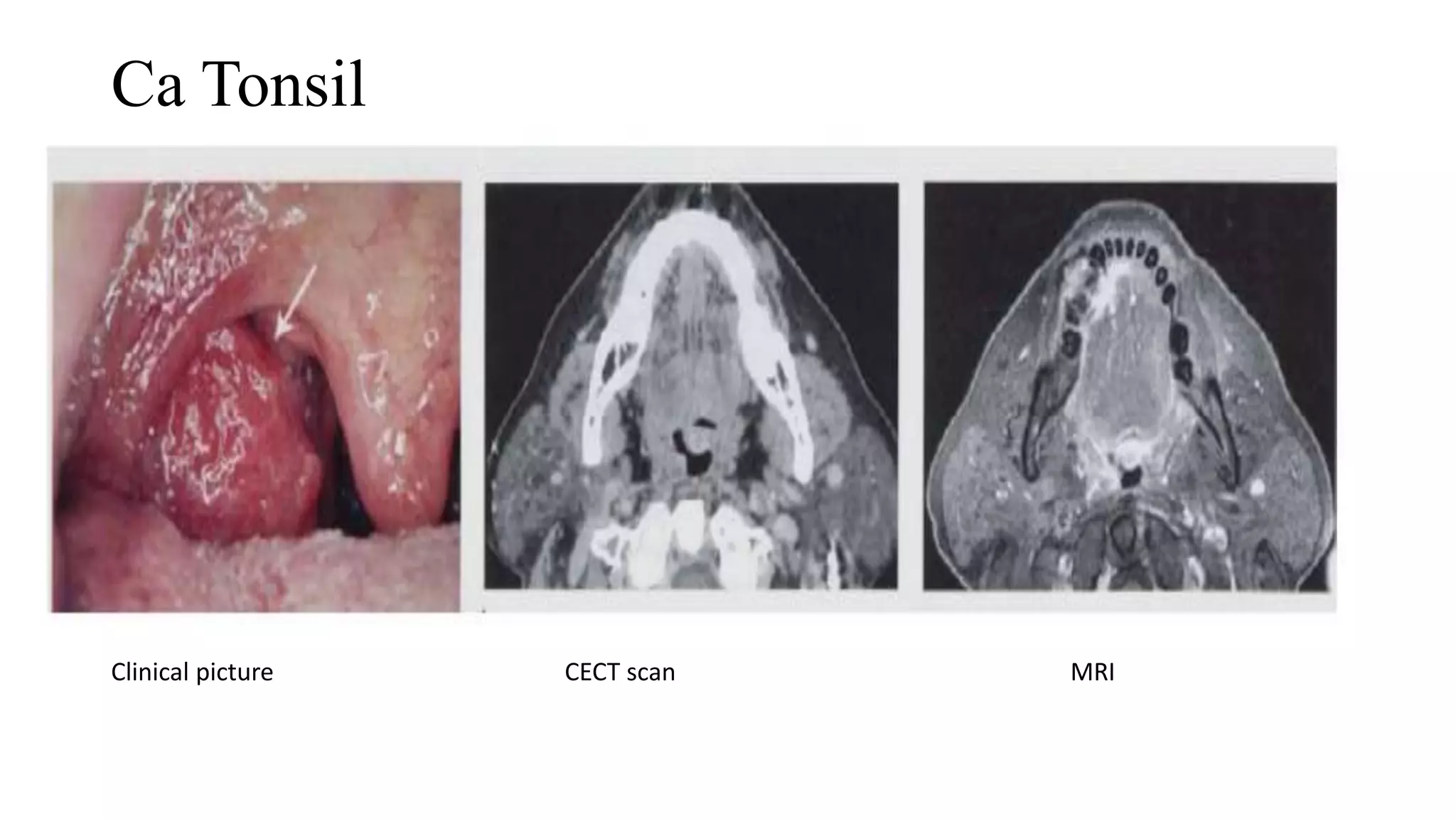 Ca Tonsil
Clinical picture CECT scan MRI
 