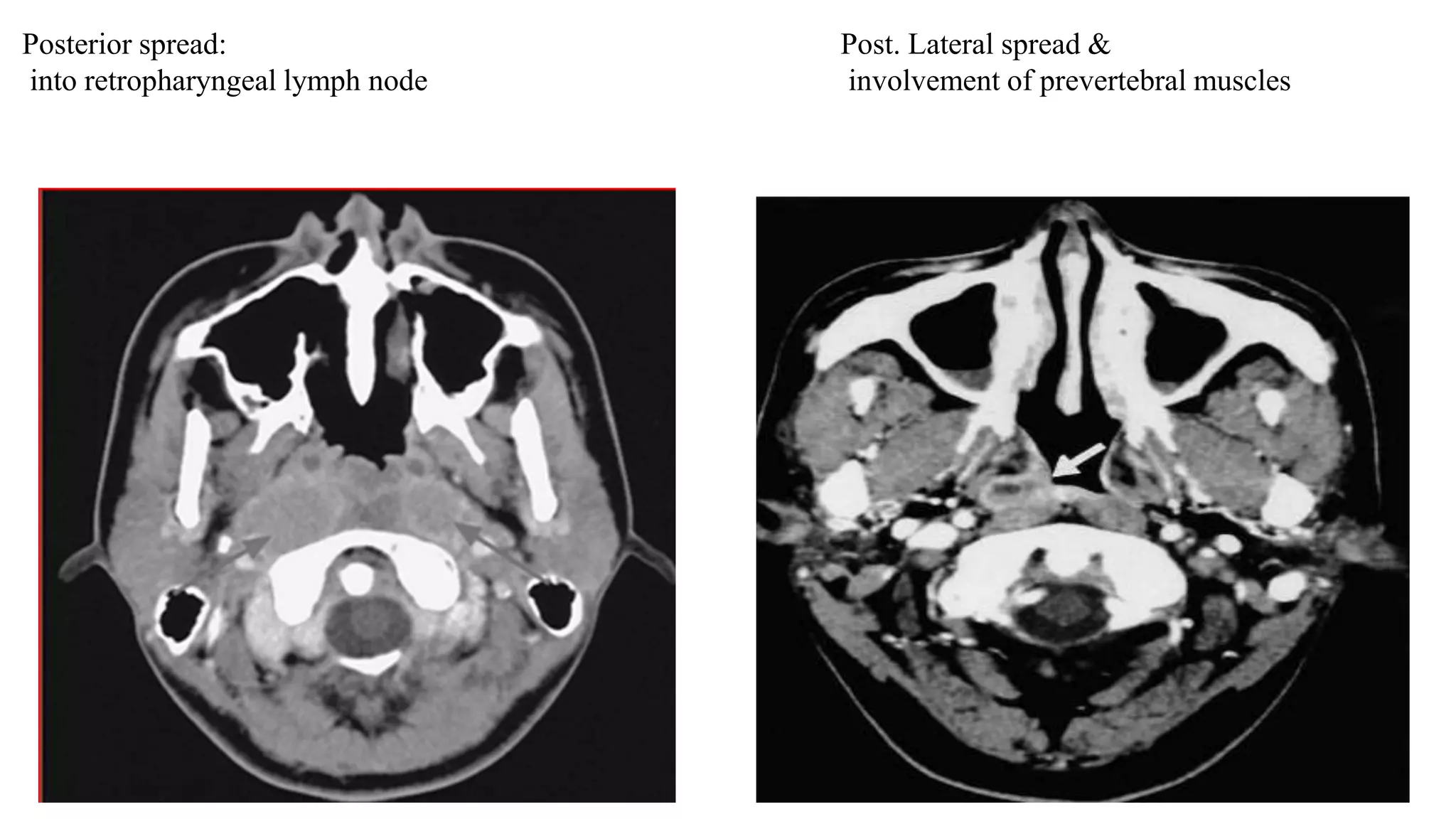 Posterior spread:
into retropharyngeal lymph node
Post. Lateral spread &
involvement of prevertebral muscles
 