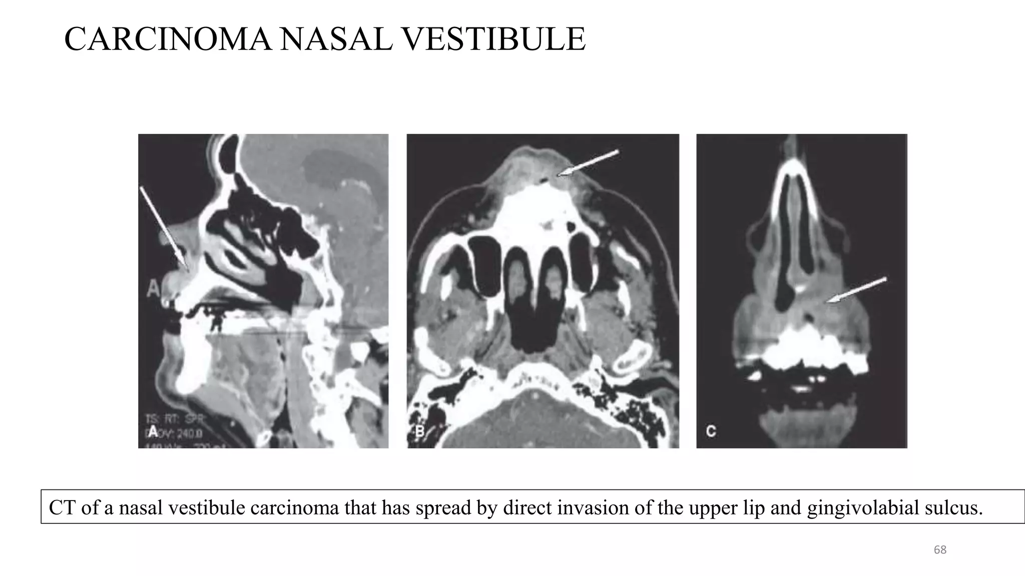 68
CT of a nasal vestibule carcinoma that has spread by direct invasion of the upper lip and gingivolabial sulcus.
CARCINOMA NASAL VESTIBULE
 