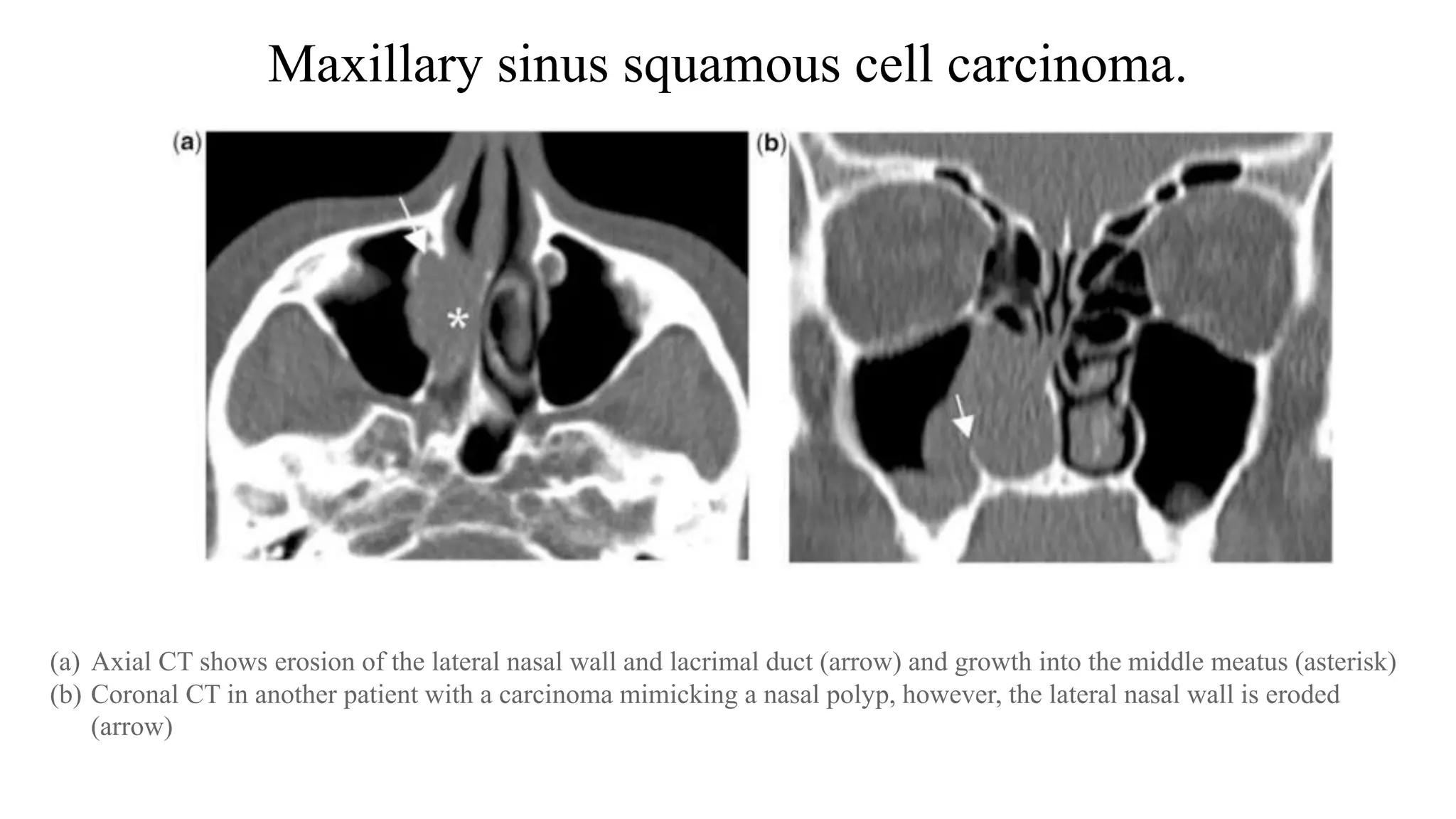 Maxillary sinus squamous cell carcinoma.
(a) Axial CT shows erosion of the lateral nasal wall and lacrimal duct (arrow) and growth into the middle meatus (asterisk)
(b) Coronal CT in another patient with a carcinoma mimicking a nasal polyp, however, the lateral nasal wall is eroded
(arrow)
 
