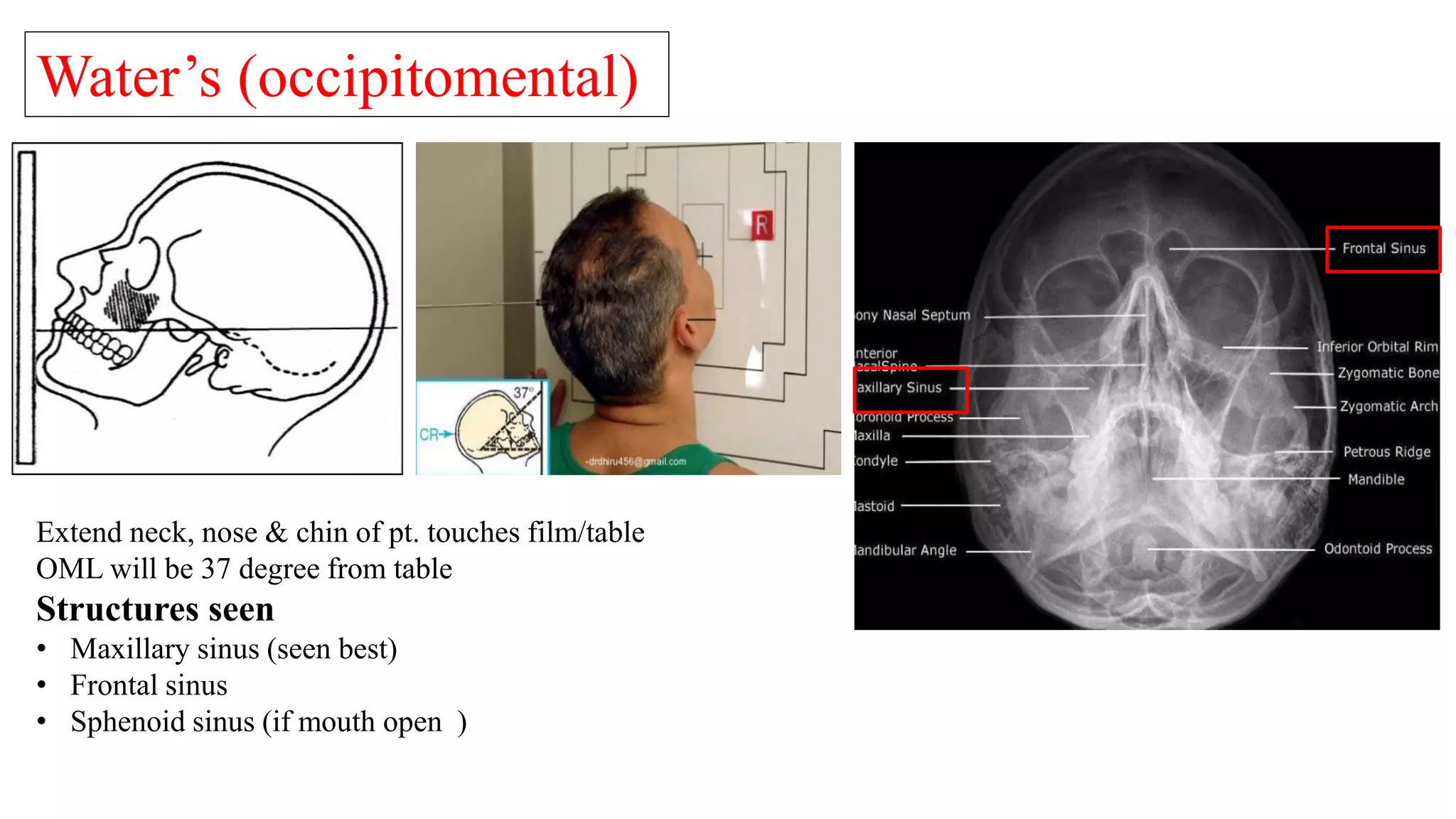 Water’s (occipitomental)
Extend neck, nose & chin of pt. touches film/table
OML will be 37 degree from table
Structures seen
• Maxillary sinus (seen best)
• Frontal sinus
• Sphenoid sinus (if mouth open )
 