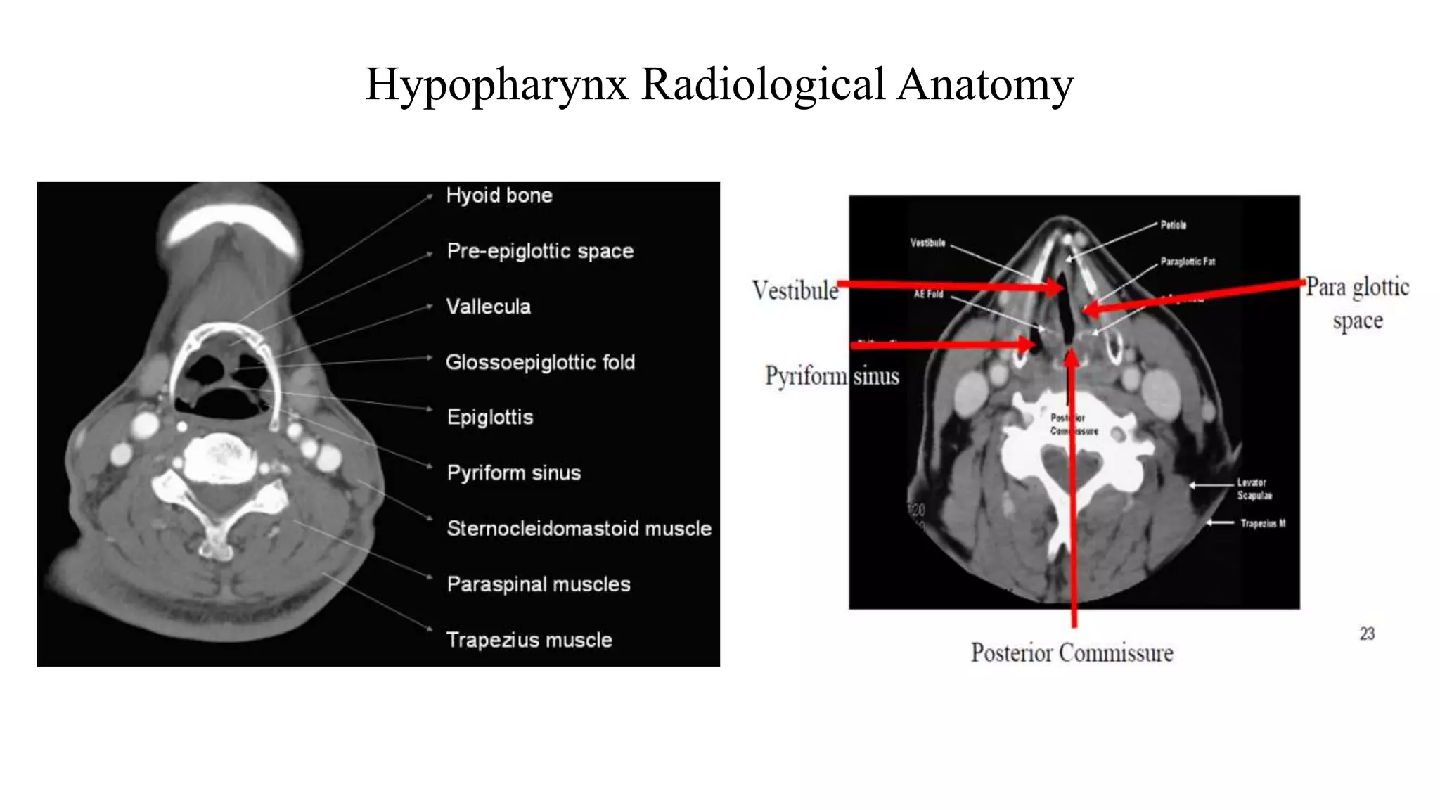 Hypopharynx Radiological Anatomy
 