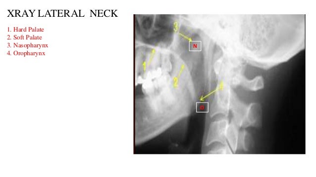 RADIO LOGICAL ANATOMY OF HEAD AND NECK CANCERS