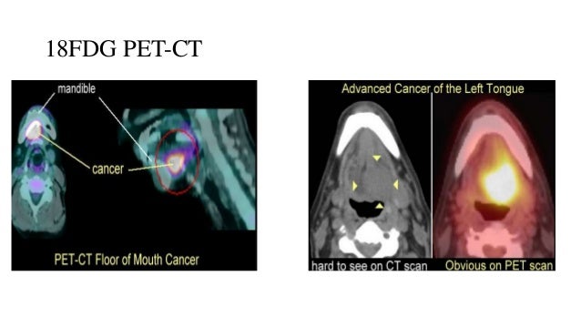 Radio Logical Anatomy Of Head And Neck Cancers