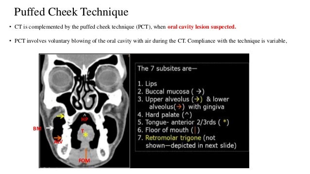 Radio Logical Anatomy Of Head And Neck Cancers