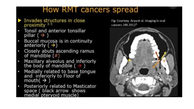 Radio Logical Anatomy Of Head And Neck Cancers