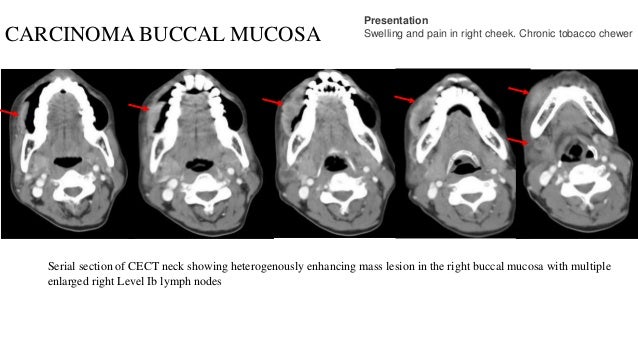 Radio Logical Anatomy Of Head And Neck Cancers