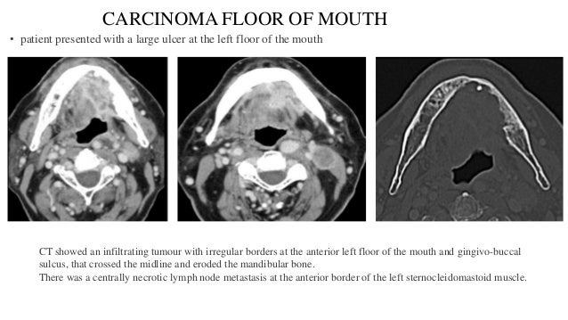 Radio Logical Anatomy Of Head And Neck Cancers