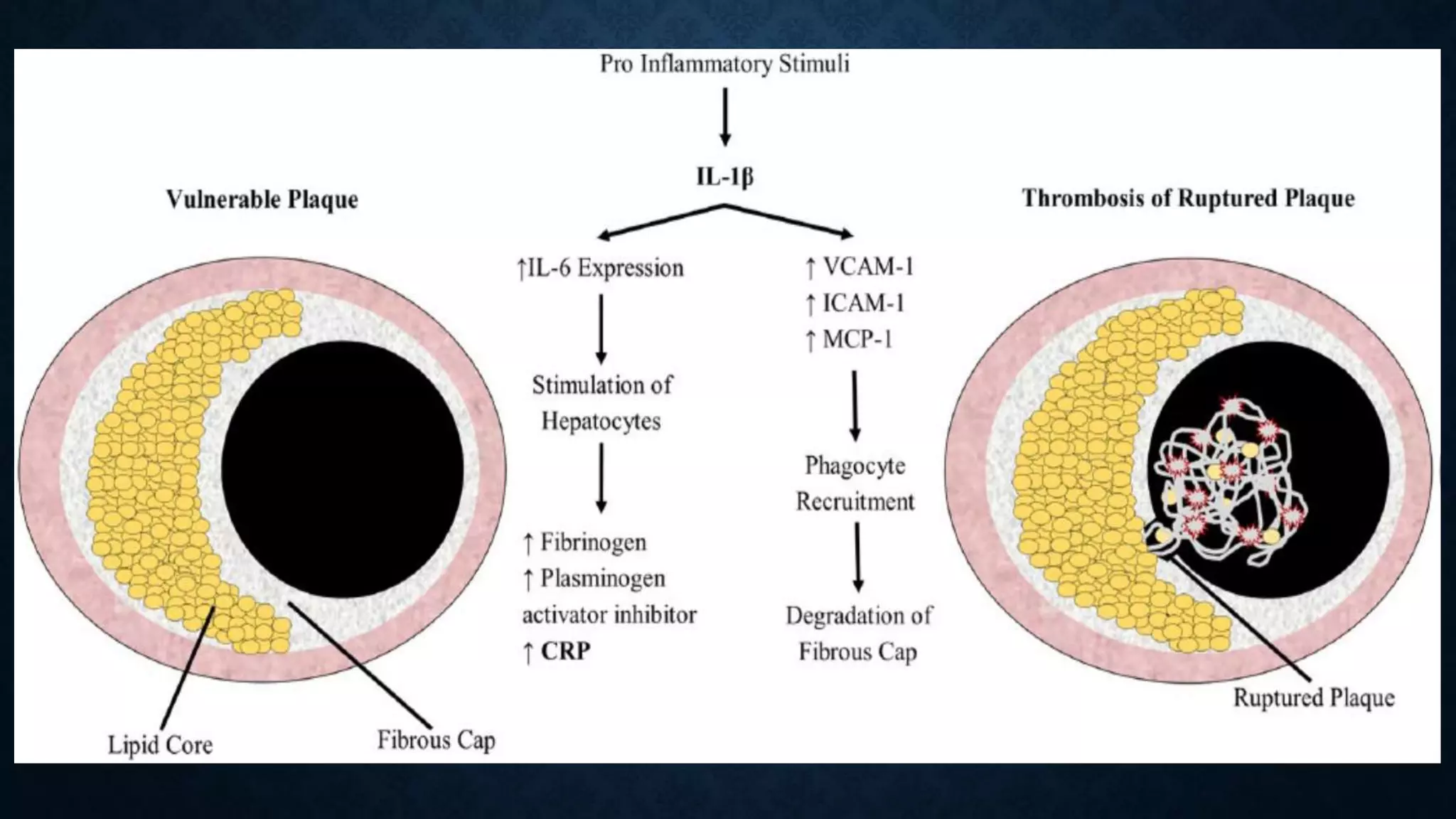 Role of inflamation in coronary artery disease | PPT