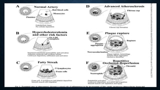 Role of inflamation in coronary artery disease | PPTX