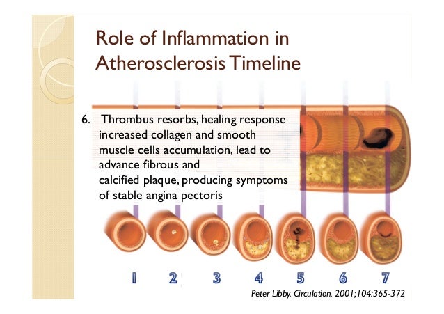 Role of Inflammation in Patophysiology of ACS