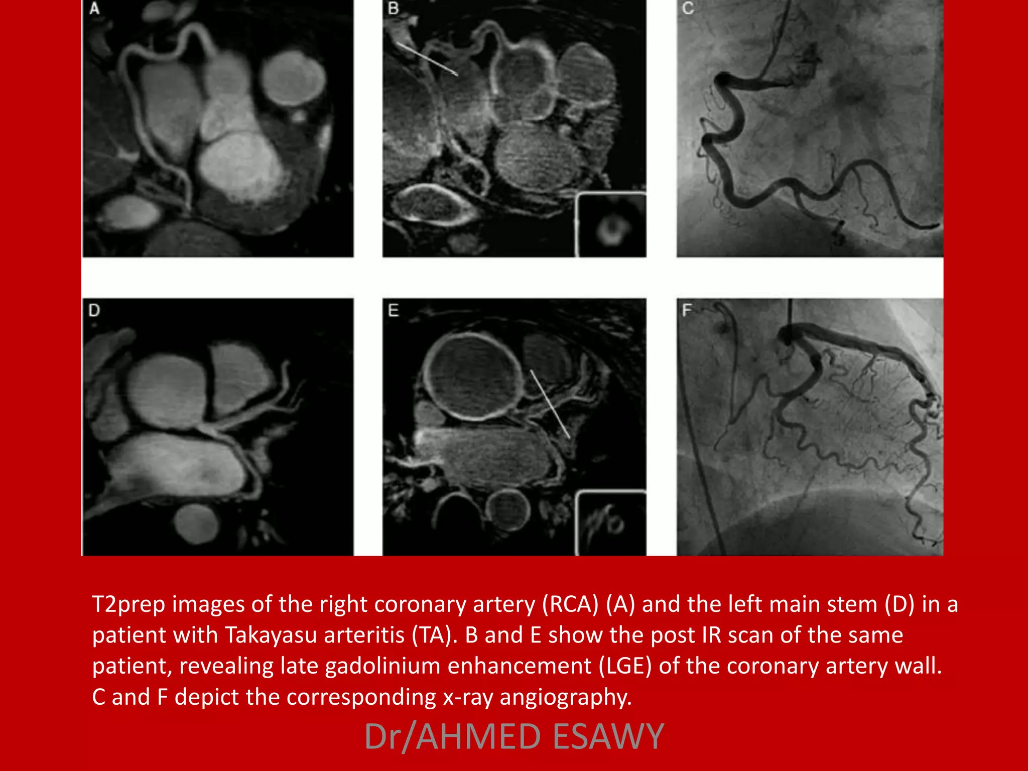 Role of magnetic resonance imaging in coronary artery disease MRCA part ...